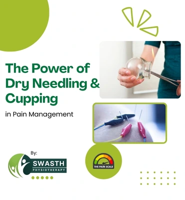The Power of Dry Needling & Cupping in Pain Management